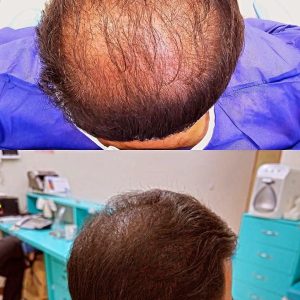 کلینیک تخصصی تاتو اسکالپ مزونیدلینگ درمان ریزش مو