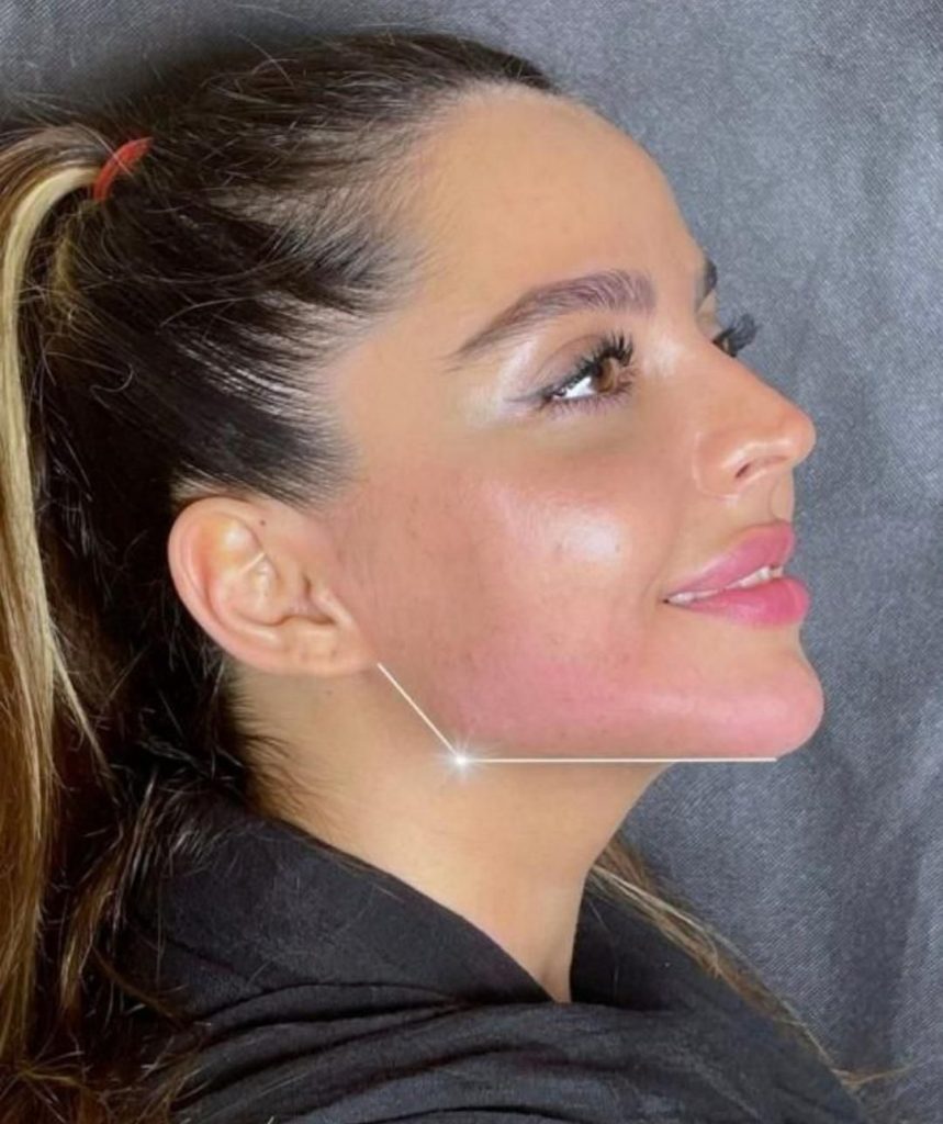 آموزش تزریق ژل،بوتاکس مزوتراپی