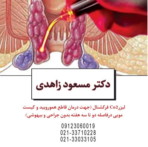 درمان قطعی هموروئید با لیزر در پیروزی