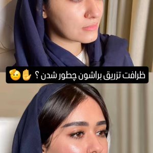 لیفت کل چهره و افزایش فاکتور های زیبایی دکتر یزدانی