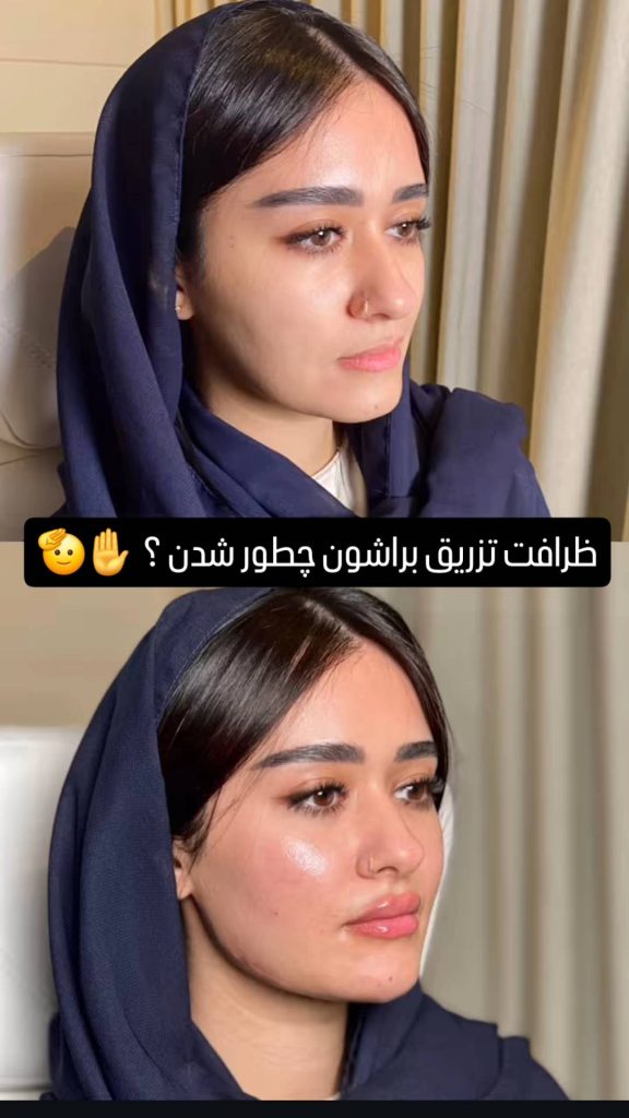 لیفت کامل چهره و افزایش فاکتورهای زیبایی با تکنیک‌های مدرن پزشکی